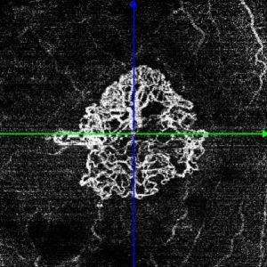 Une image OCT-A d'un néovaisseau choroidien dans la DMLA