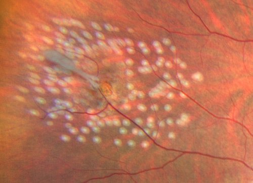 Photo d'un cerclage laser autour d'un trou dans la rétine