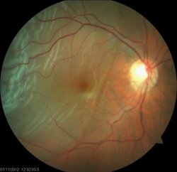 dr macula off