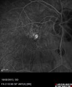 nvc myope