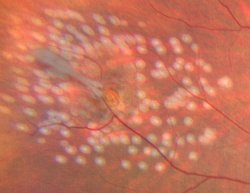 Photo d'un trou rétinien après le traitement au laser