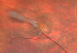 Photo d'un trou rétinien avant traitement par laser